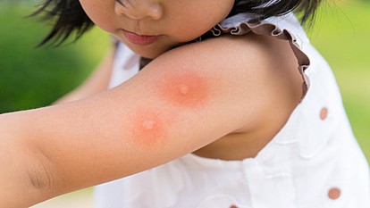 Заштитете се од здодевните комарци со природни средства кои ги имате дома