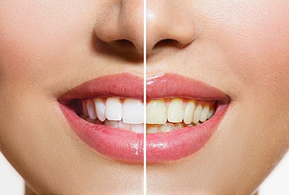 Природно белење на забите дома што вреди да се испроба